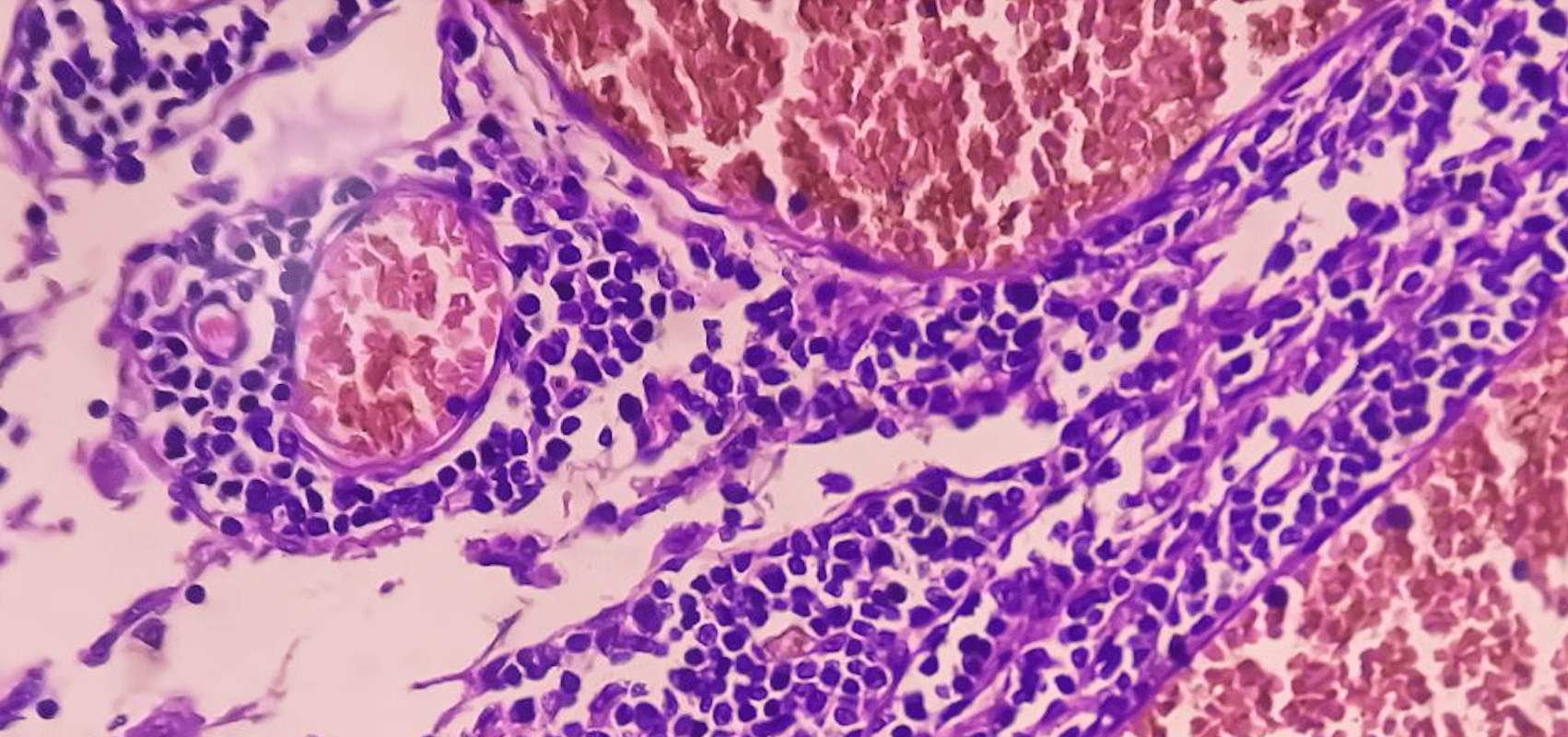 Zolbetuximab'ın AB onayından sonra: İlaç hastalara ne zaman sunulacak?